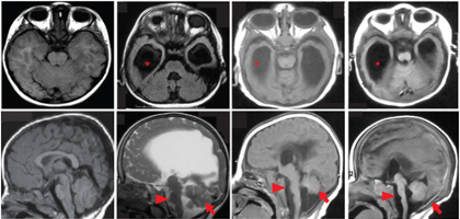 Images show enlarged brain parts in affected children